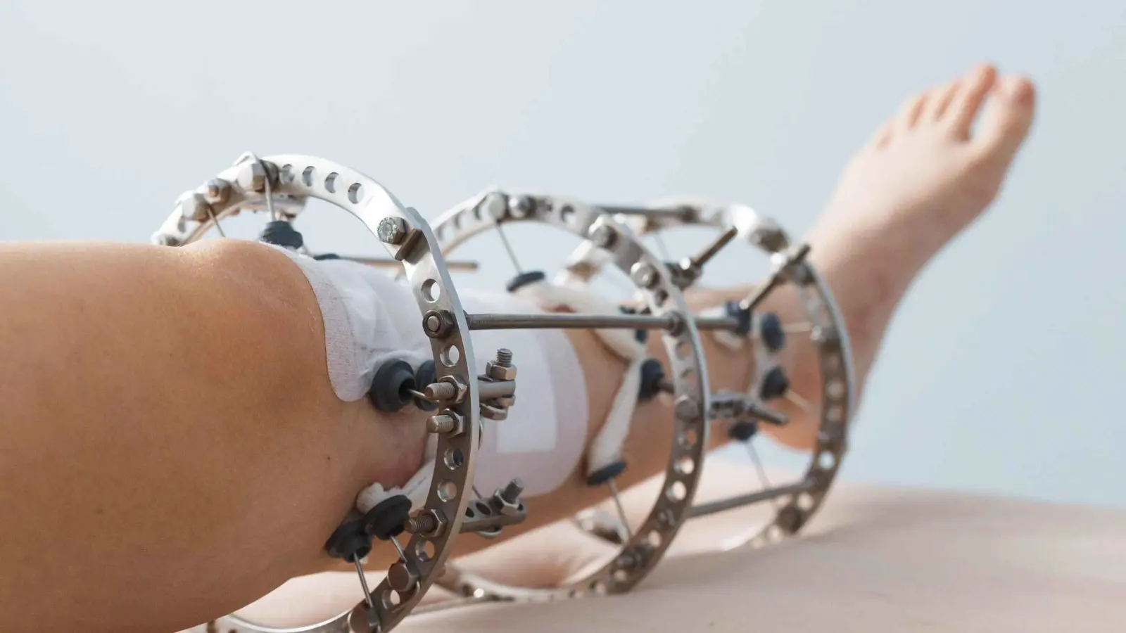 كيف تحولت جراحة إطالة الساق إلى موضة تجميلية؟