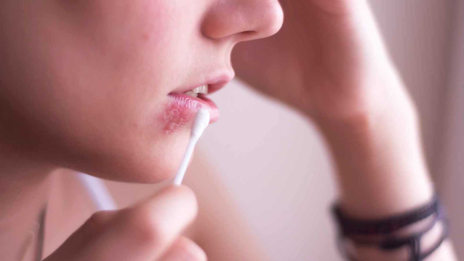 الكشف عن وسيلة مبتكرة لمكافحة فيروسات الهربس