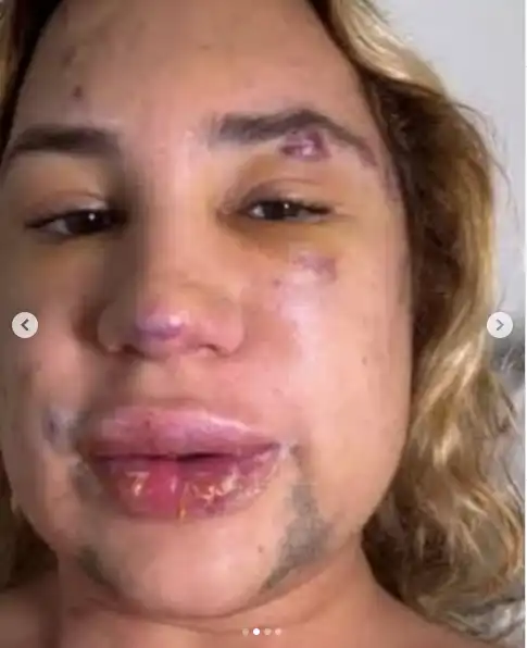 دوترا جونيور بعد الخضوع للعملية