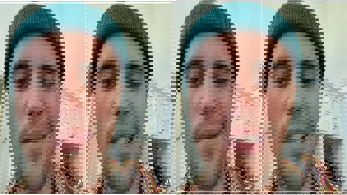 بعد إصابة جاستين بيبر.. ما هي متلازمة رامزي هانت وطرق علاجها؟