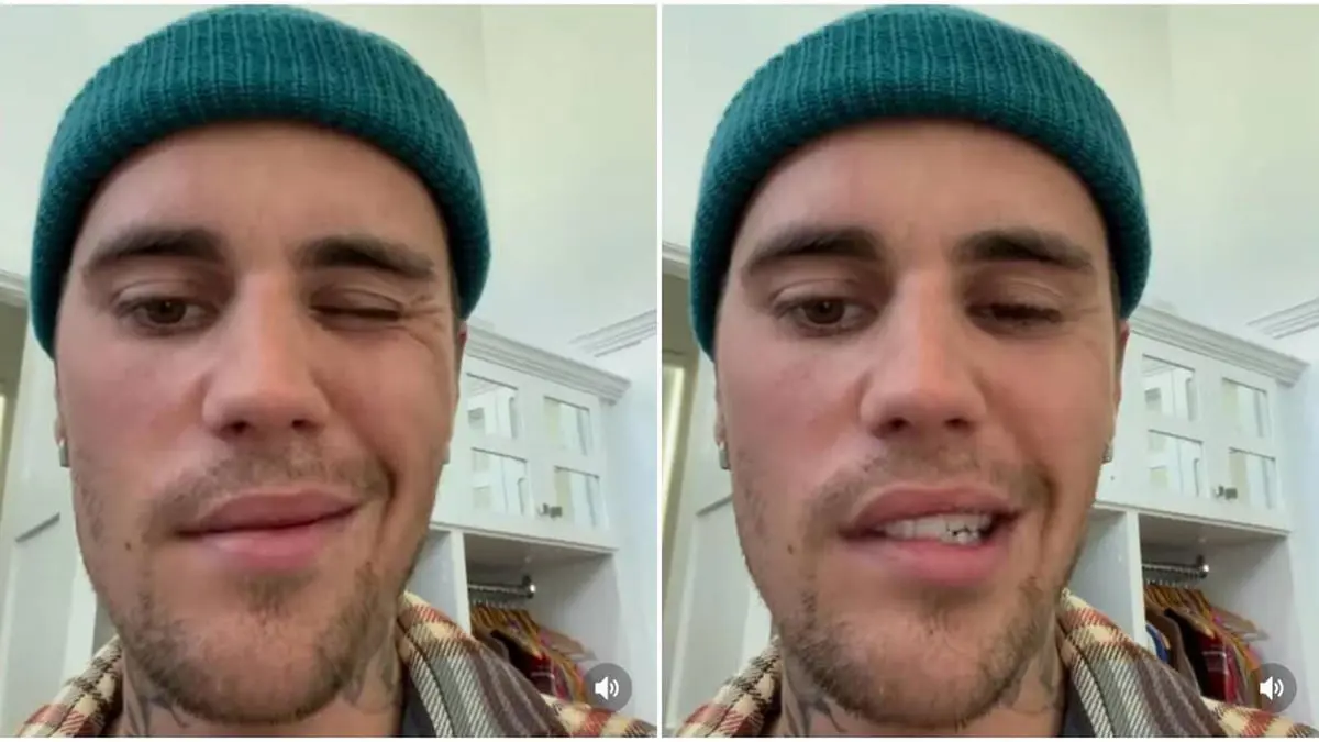 بعد إصابة جاستين بيبر.. ما هي متلازمة رامزي هانت وطرق علاجها؟