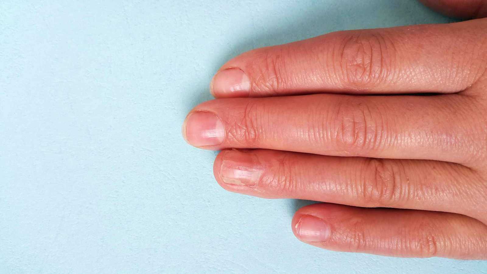 علامة غريبة على أطراف الأصابع قد تكشف الإصابة بسرطان الرئة مبكراً