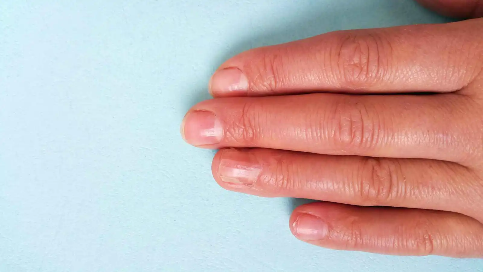 علامة غريبة على أطراف الأصابع قد تكشف الإصابة بسرطان الرئة مبكراً