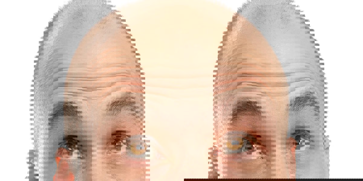 تقرير يكشف الدول الأعلى في نسبة "الصلعان"