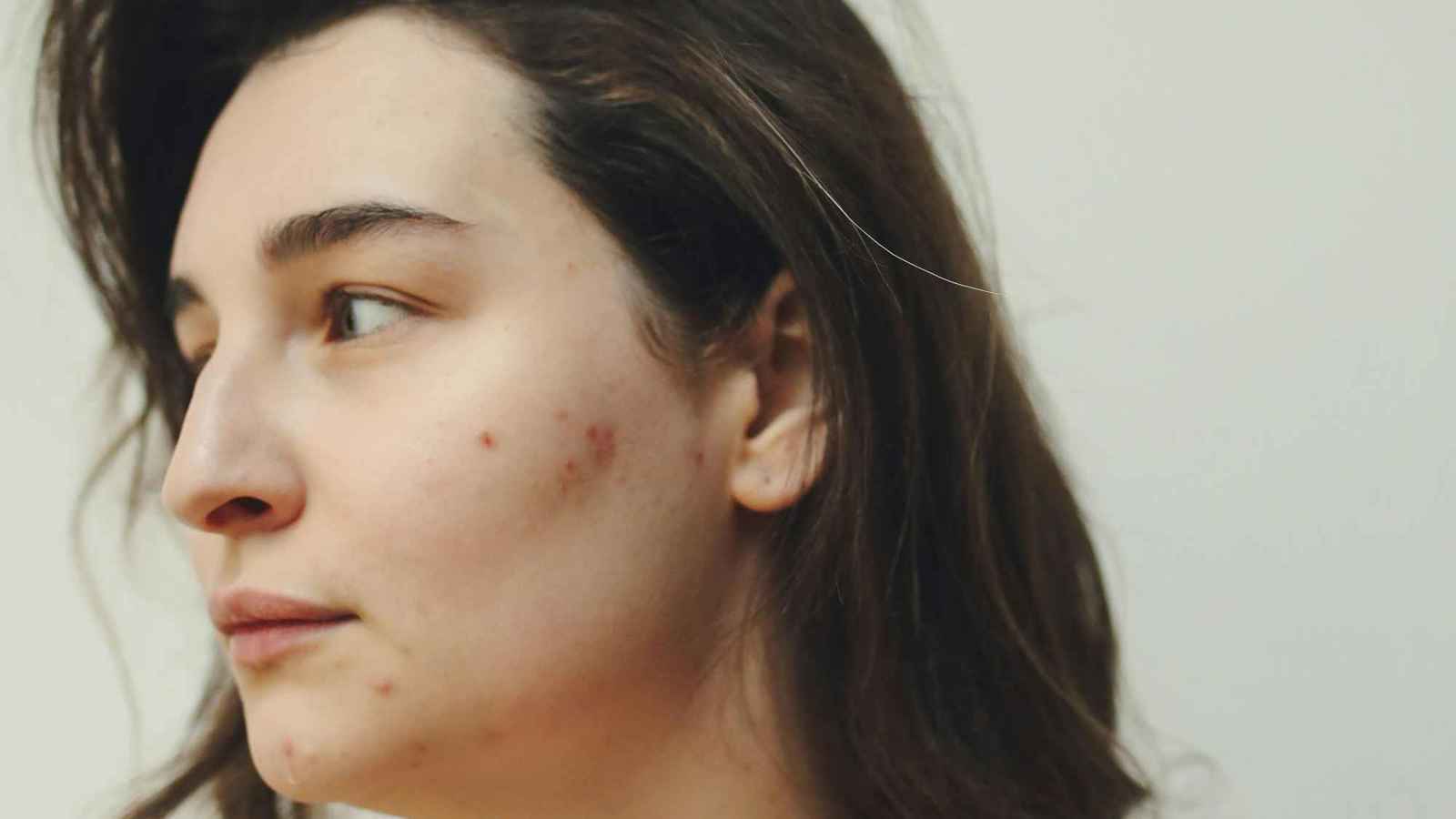 ترند "تيك توك".. هل تكشف مشاكل البشرة عن العلاقات السامة؟