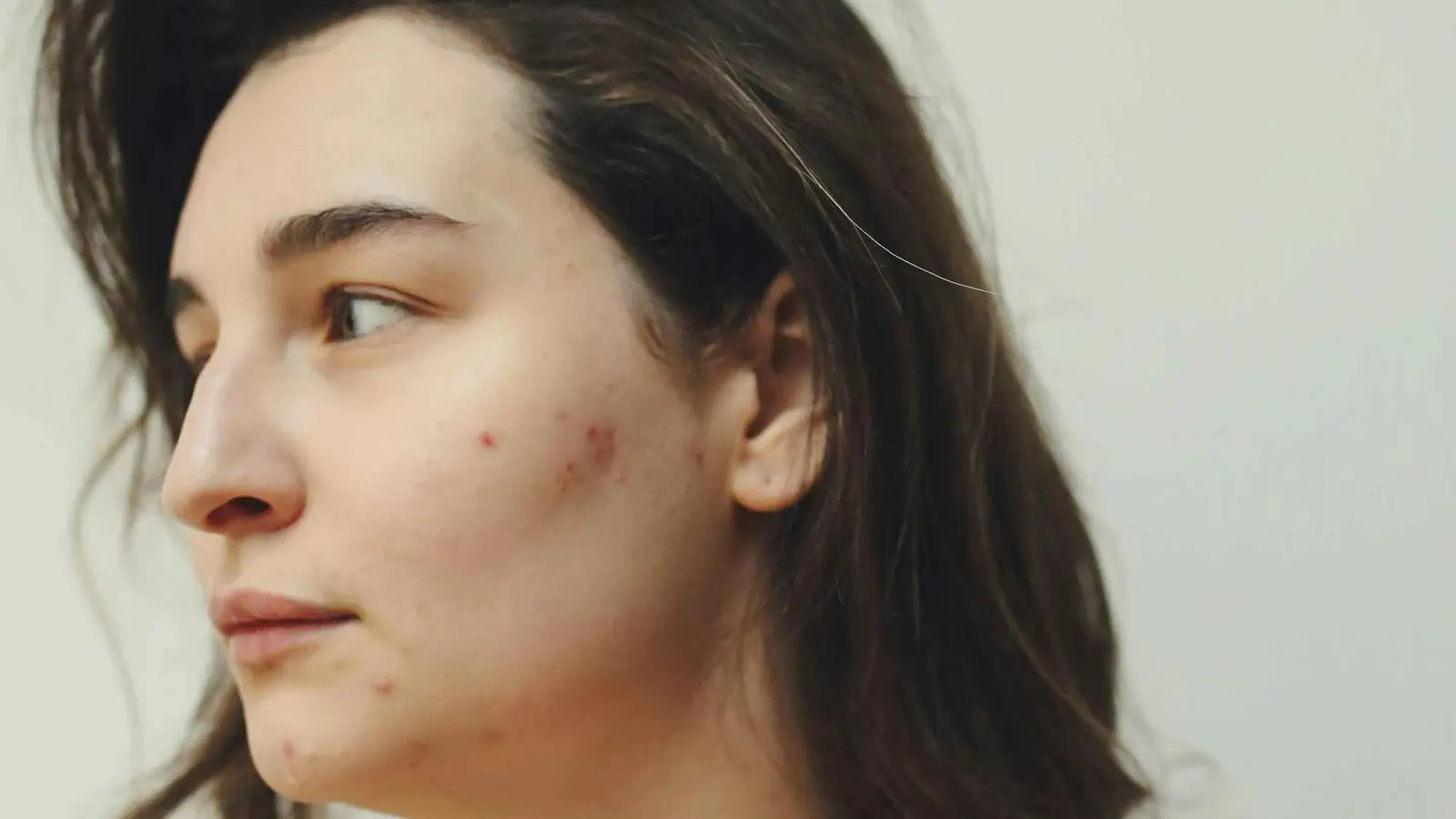 ترند "تيك توك".. هل تكشف مشاكل البشرة عن العلاقات السامة؟