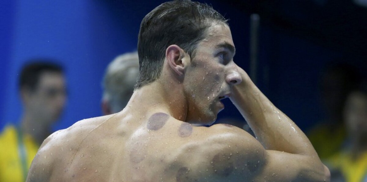 الأمريكيون يستعينون بـ"الحجامة" لاقتناص ذهب أولمبياد ريو (صور)