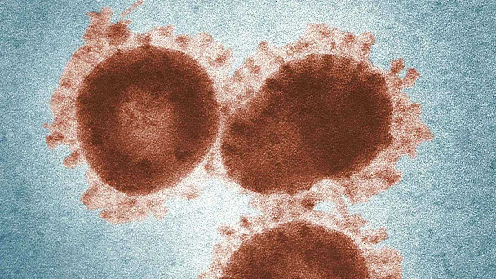 فيروس شائع يزيد خطر الإصابة بـ"الخرف" بنسبة 7 مرات