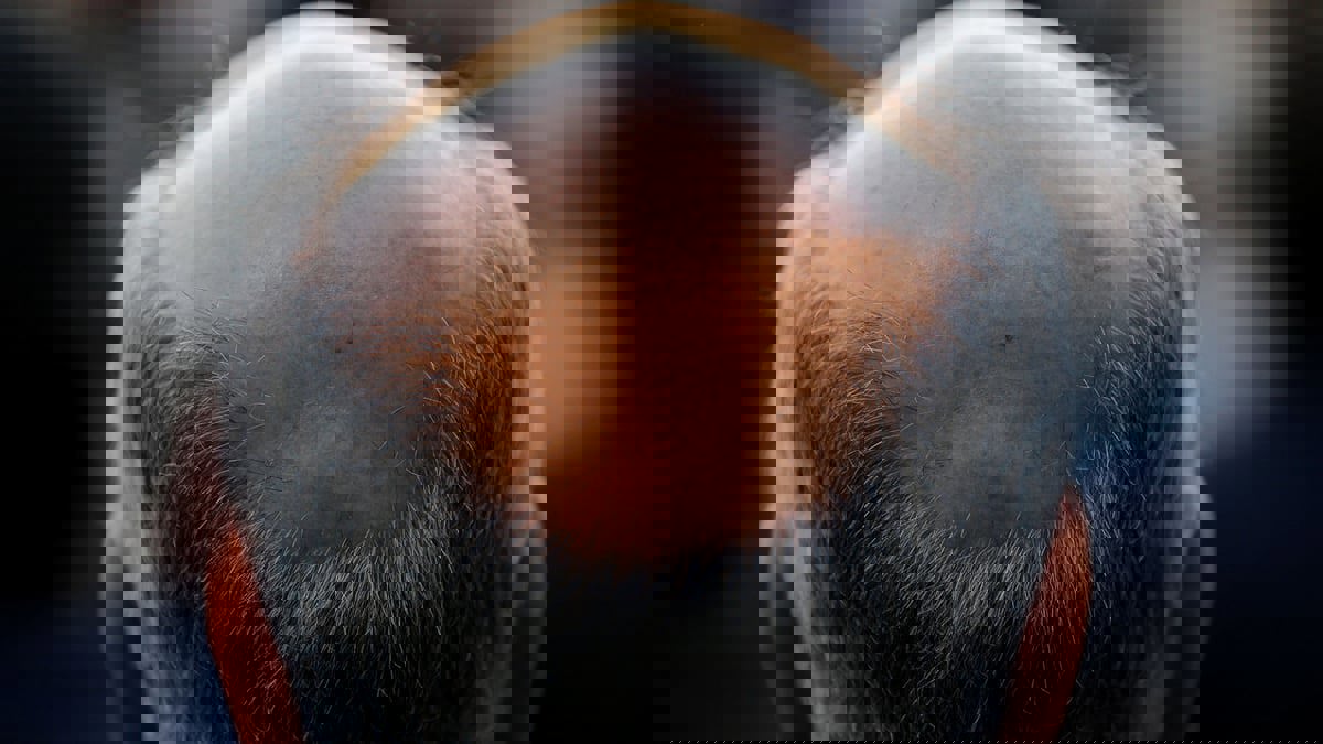 آخر ما توصل إليه الطب الحديث لعلاج تساقط الشعر