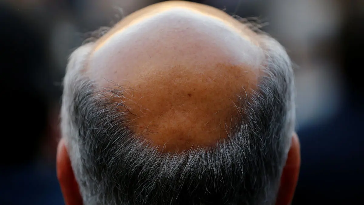 آخر ما توصل إليه الطب الحديث لعلاج تساقط الشعر