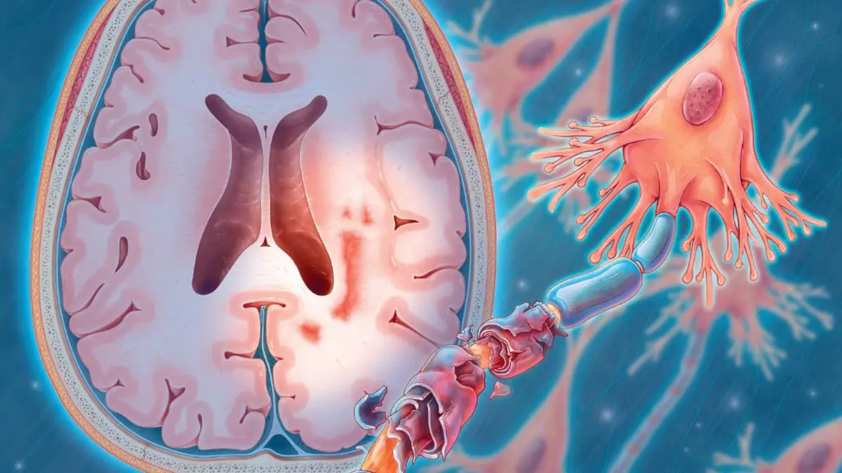 ثورة طبية قد توقف التصلب اللويحي في مراحله المتقدمة 