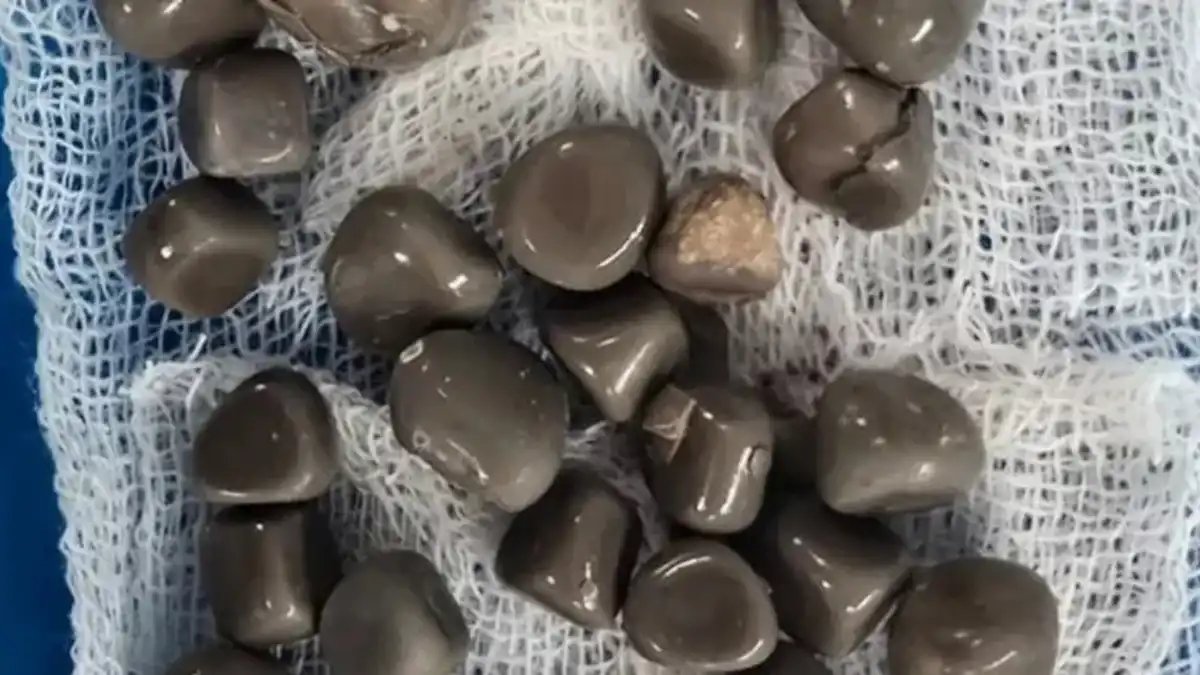 استئصال الحصى من كلية مريض مصري