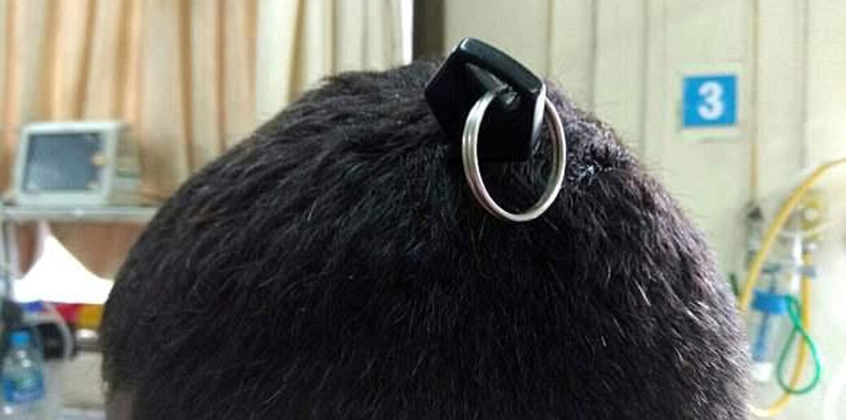 شاب يصدم الأطباء بمفتاح دراجة نارية في جمجمته (صور)