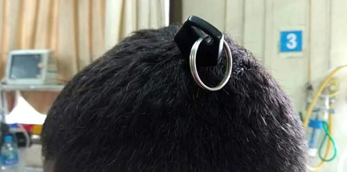 شاب يصدم الأطباء بمفتاح دراجة نارية في جمجمته (صور)