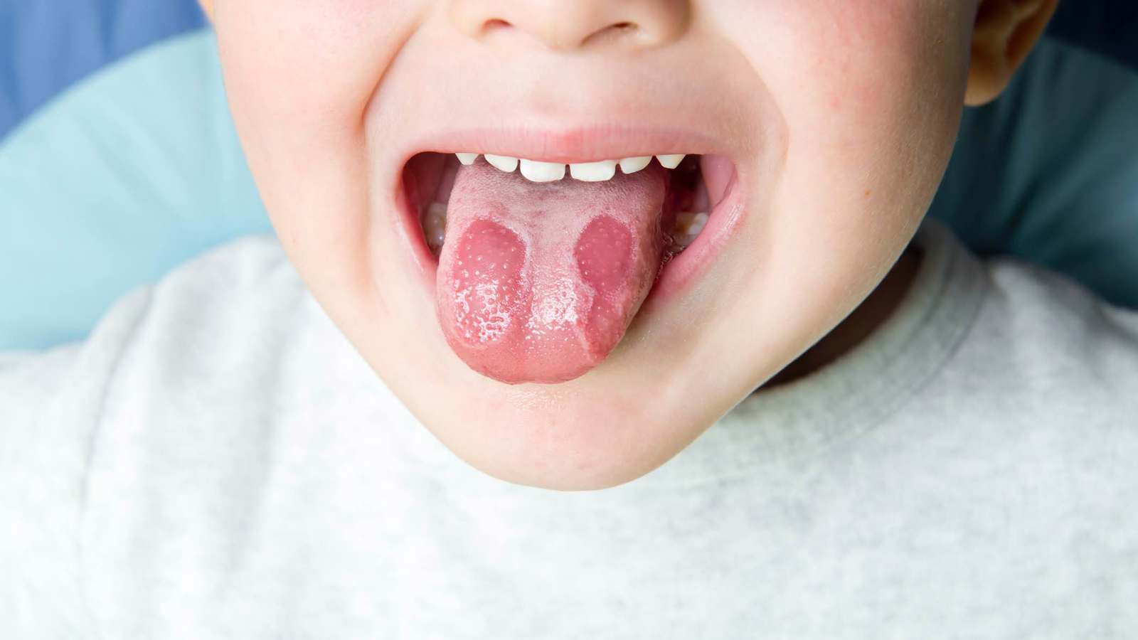 طرق "بسيطة" لمعالجة حروق اللسان