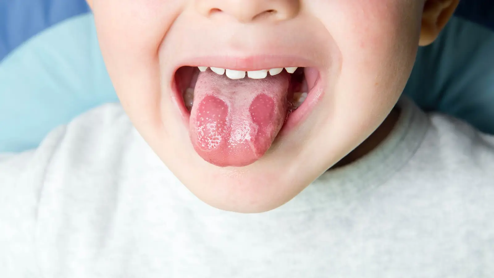 طرق "بسيطة" لمعالجة حروق اللسان