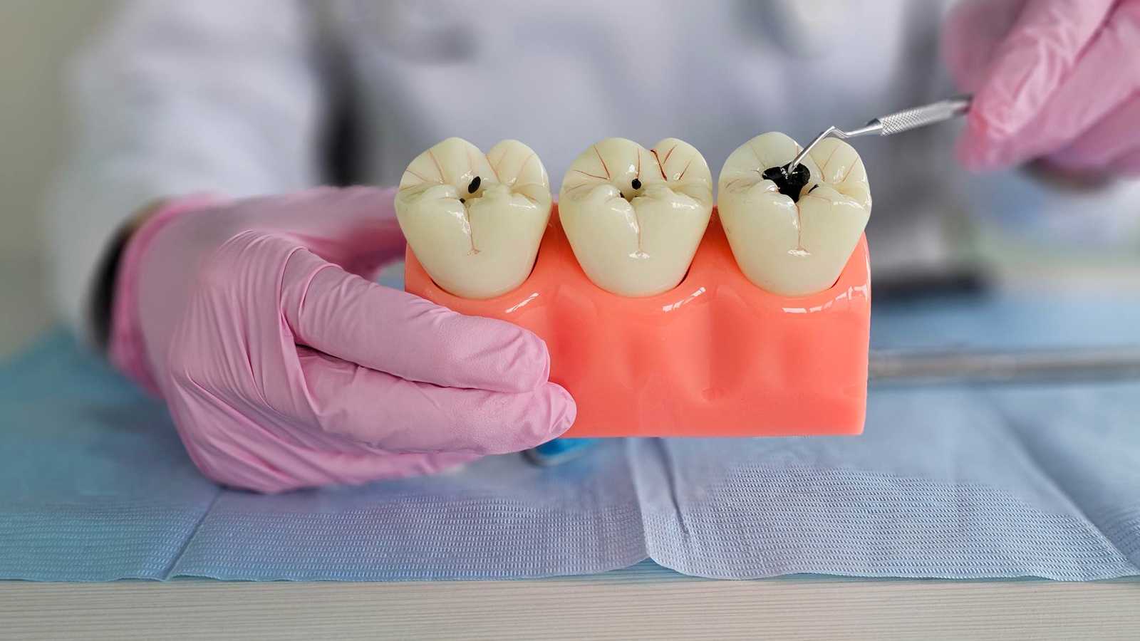 معجون أسنان بـ"بروتين الشعر" لعلاج التسوس