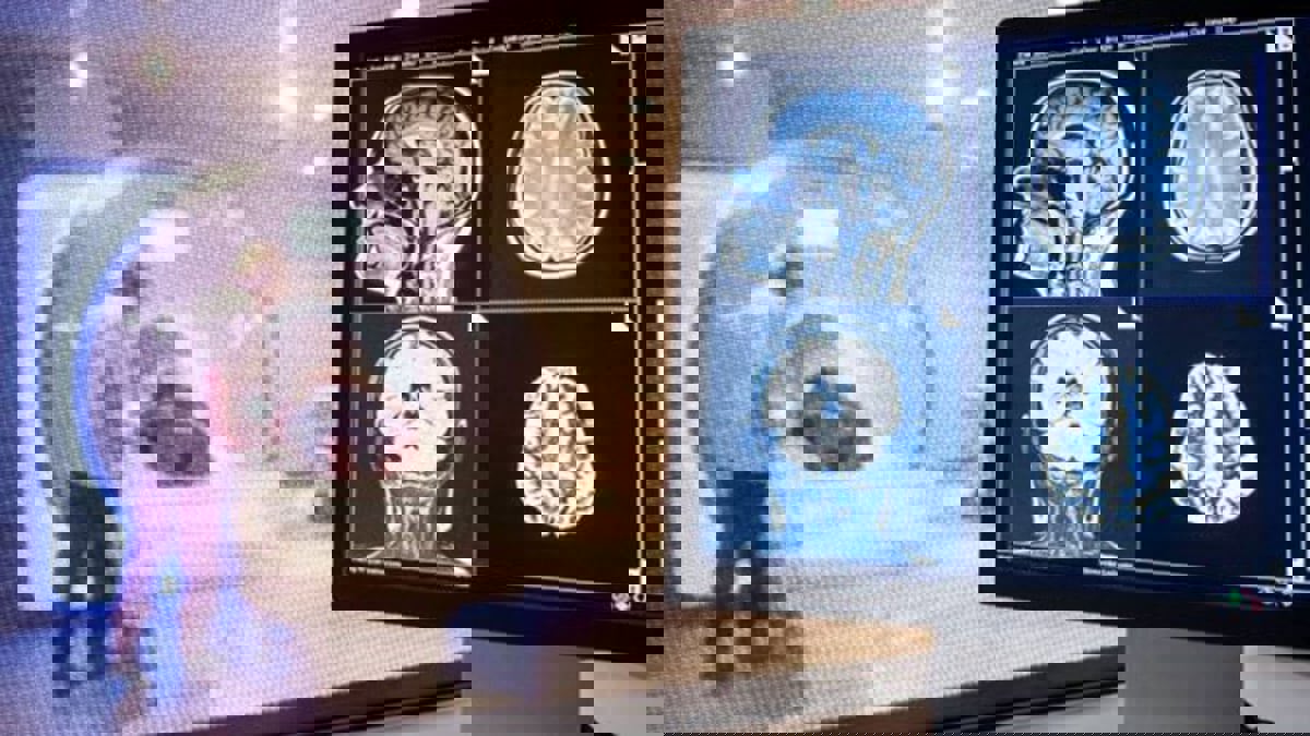 دراسة حديثة تكشف "صلة وثيقة" بين كورونا وأمراض الدماغ