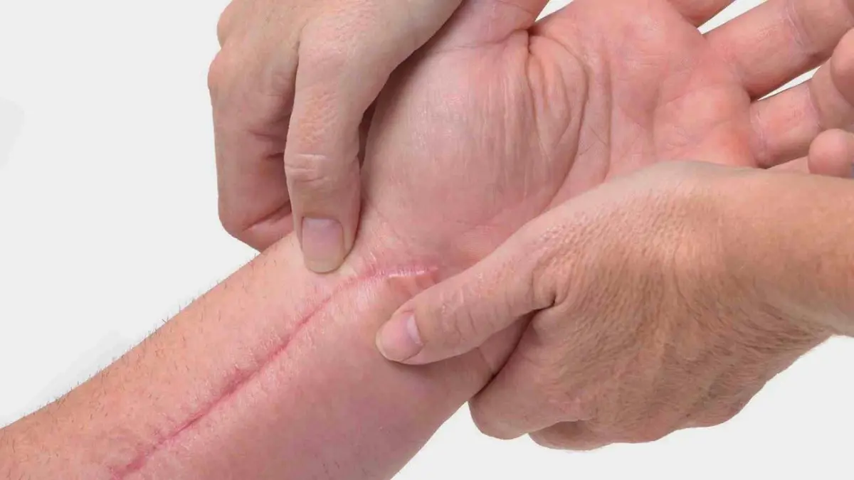 ابتكار جل مشحون كهربائيًا لعلاج الجروح المزمنة‎‎
