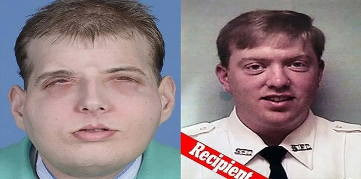 بالصور.. رجل يخضع لعملية زراعة وجه الأكثر نجاحاً في التاريخ