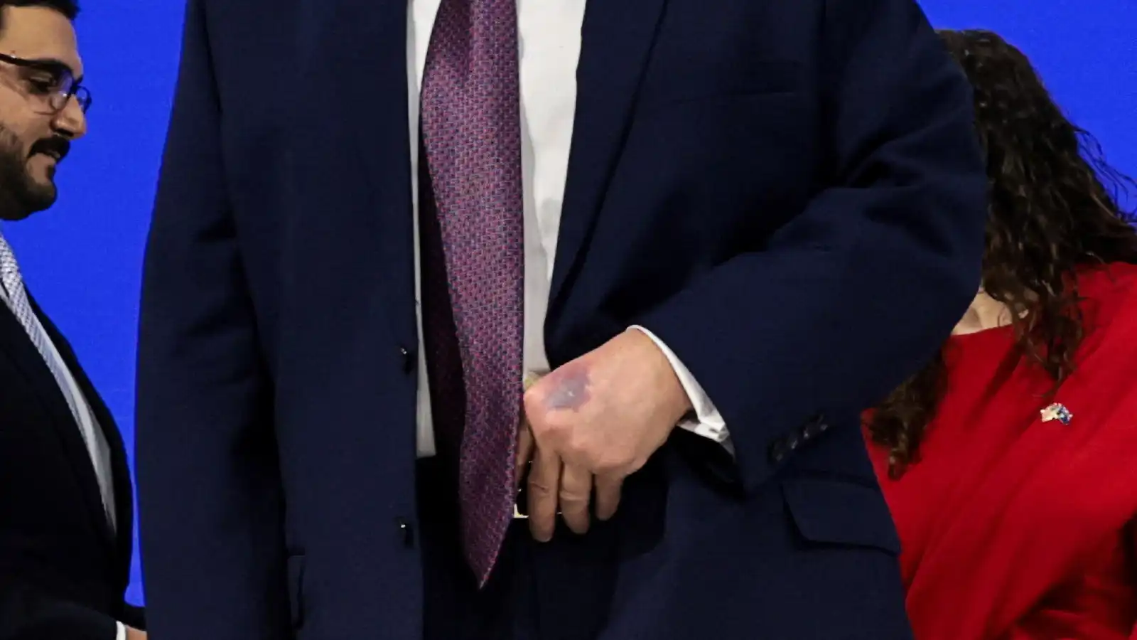 ترامب يكشف سر "أحدث كدمة" على يده وسبب رفض نصيحة الطبيب (فيديو)