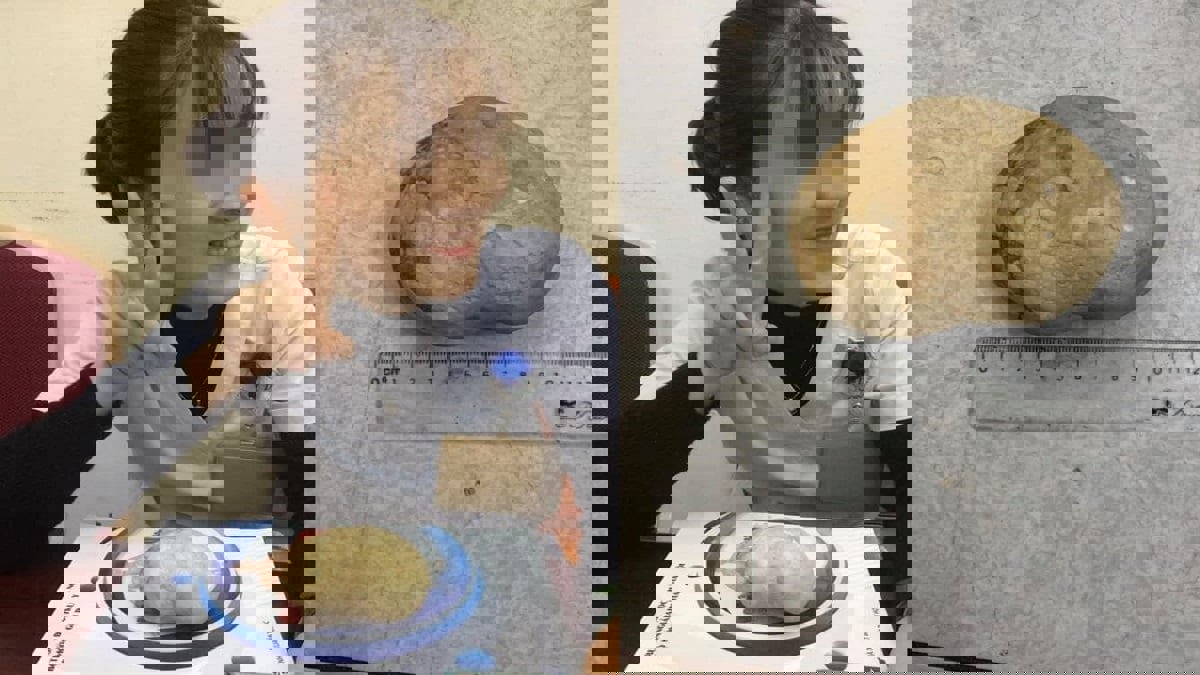 إزالة حصوة عملاقة تزن 400 غرام من مثانة سيدة (صور)