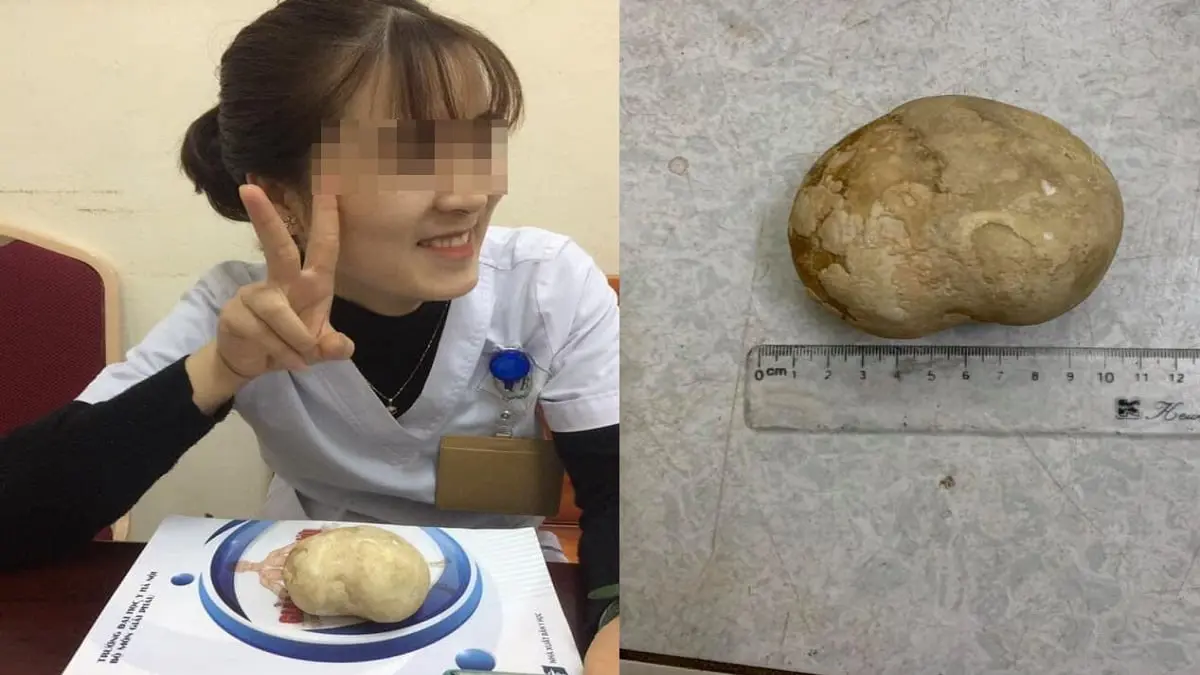 إزالة حصوة عملاقة تزن 400 غرام من مثانة سيدة (صور)