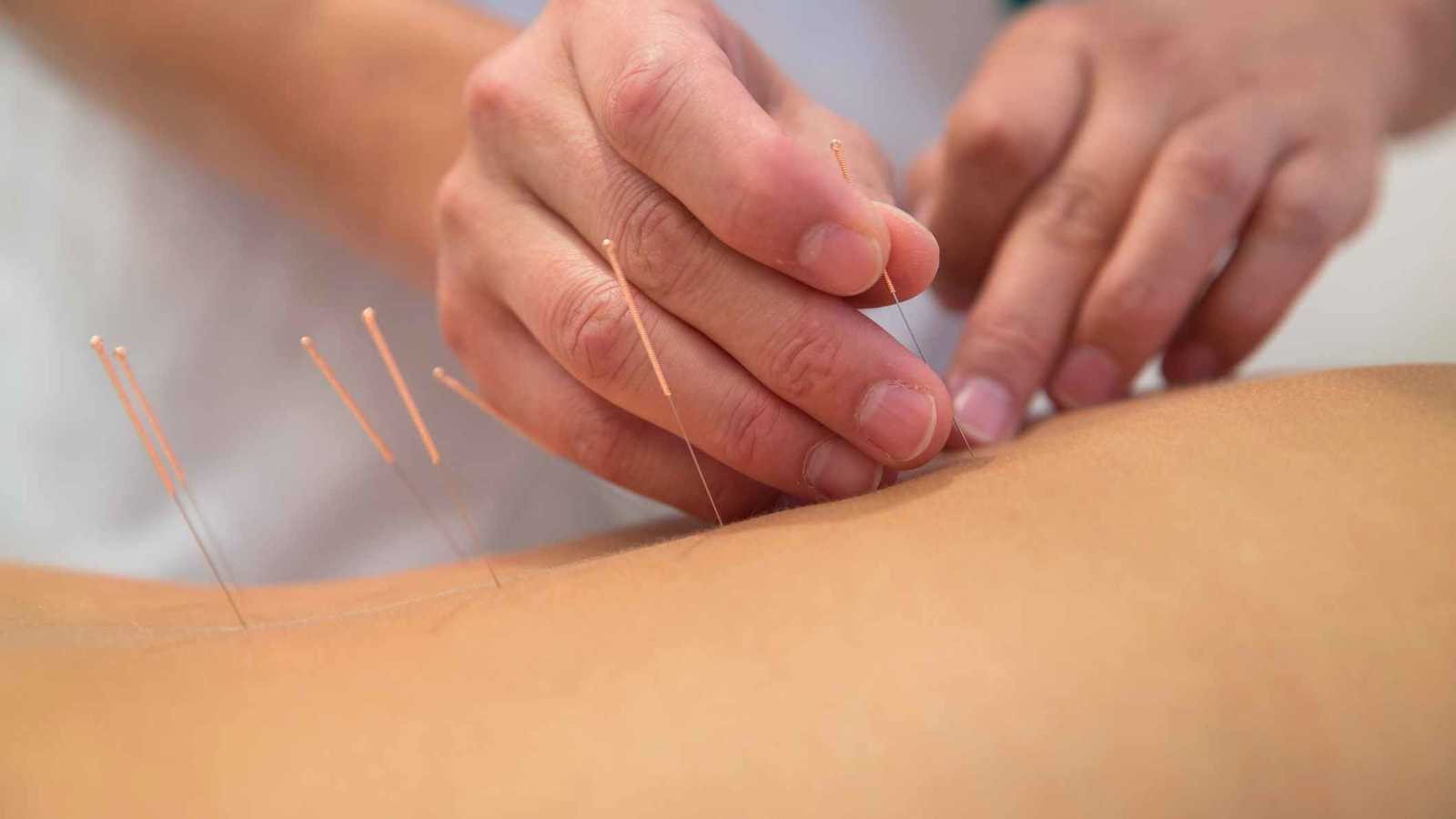 العلاج بالإبر الصينية.. نتائج فعالة أم دعاية وهمية؟