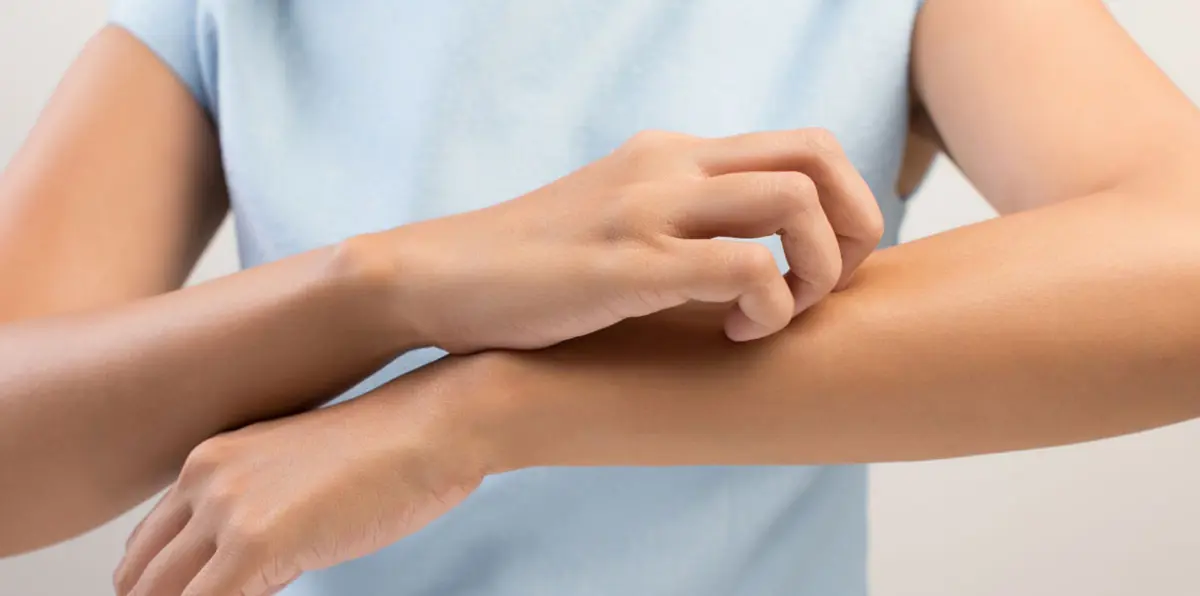 السعودية.. توجيهات جديدة بخصوص مرض الجرب