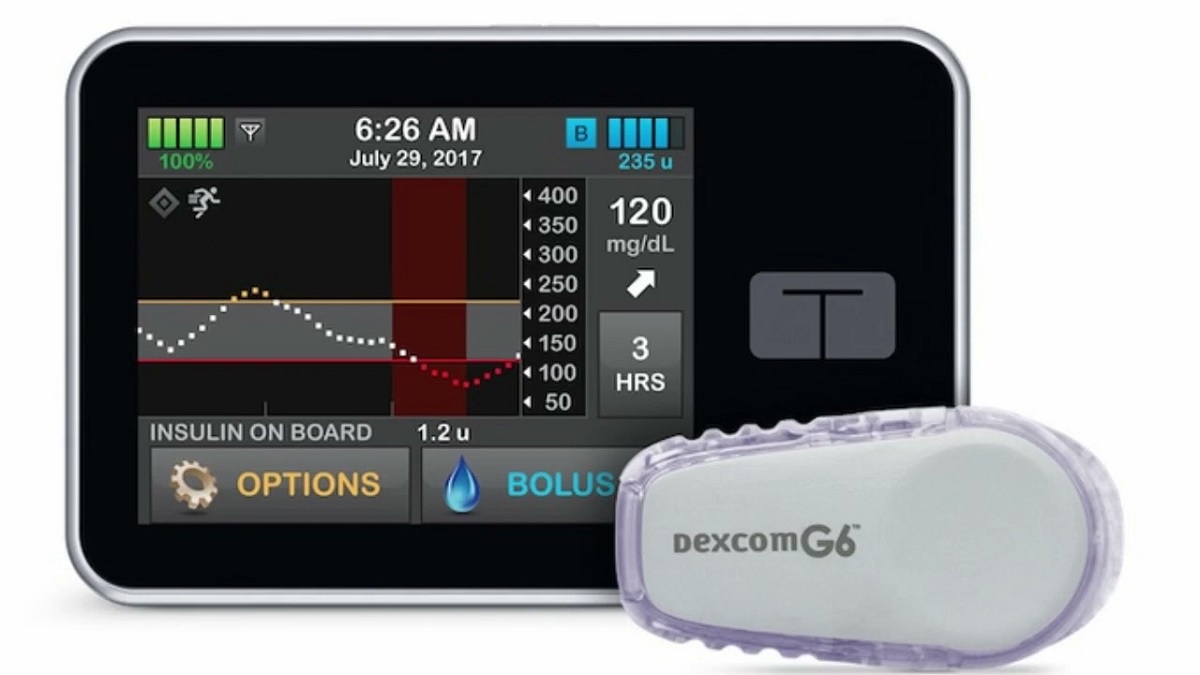 بنكرياس اصطناعي يتحكم في نسبة سكر الدم