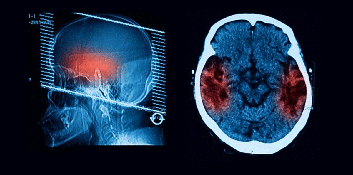 علماء ينجحون في علاج مرض الزهايمر لدى الفئران