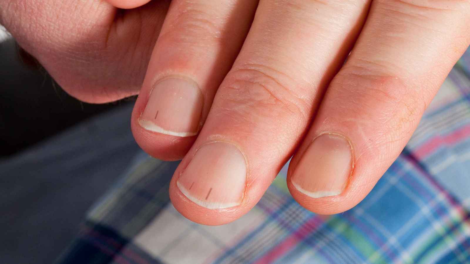 5 علامات لا تتجاهلها.. كيف تخبرك "بشرتك" بأن قلبك في خطر؟