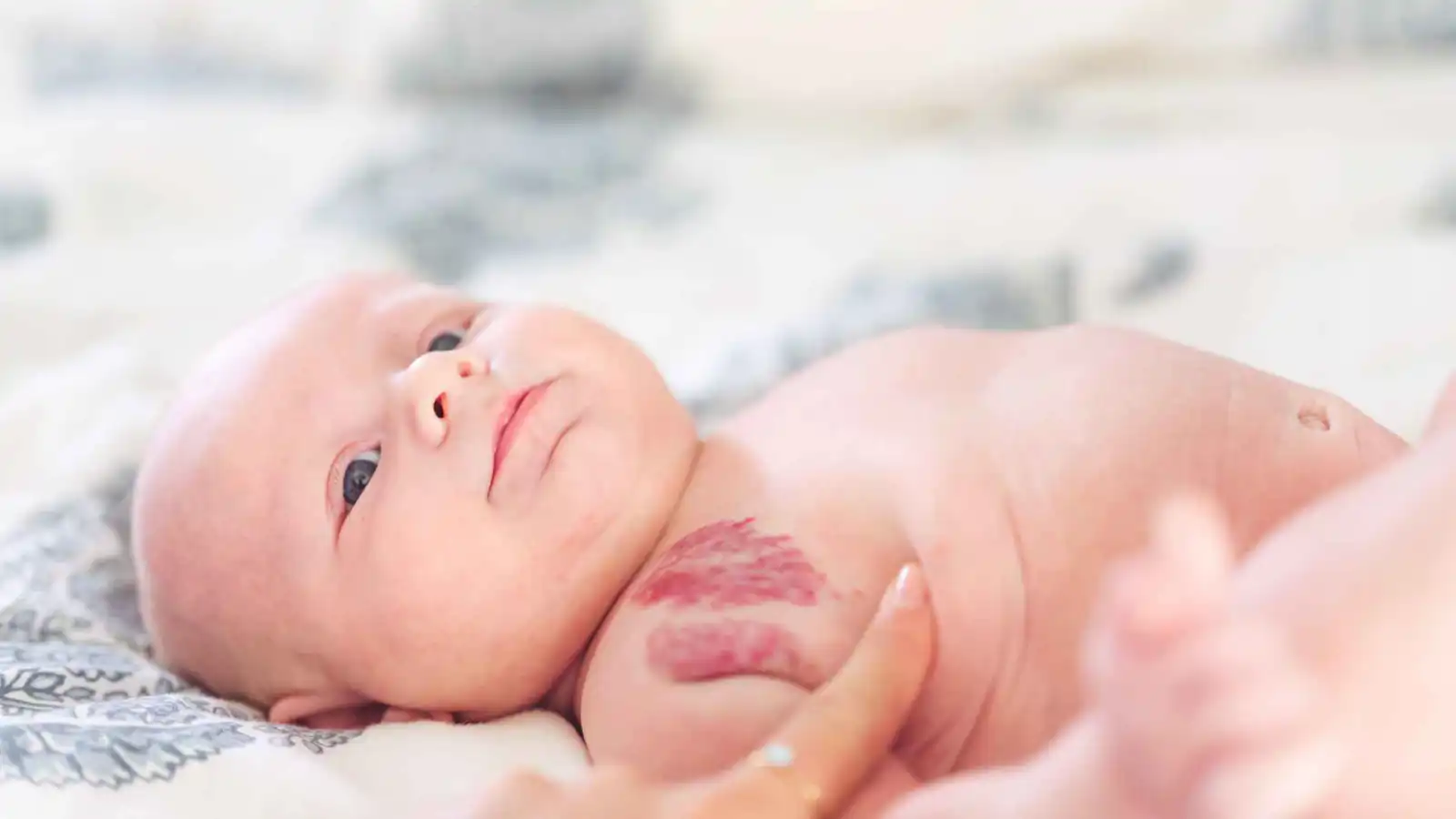 الوحمة عند الرضع.. متى تختفي؟ ومتى تستدعي متابعة طبية؟