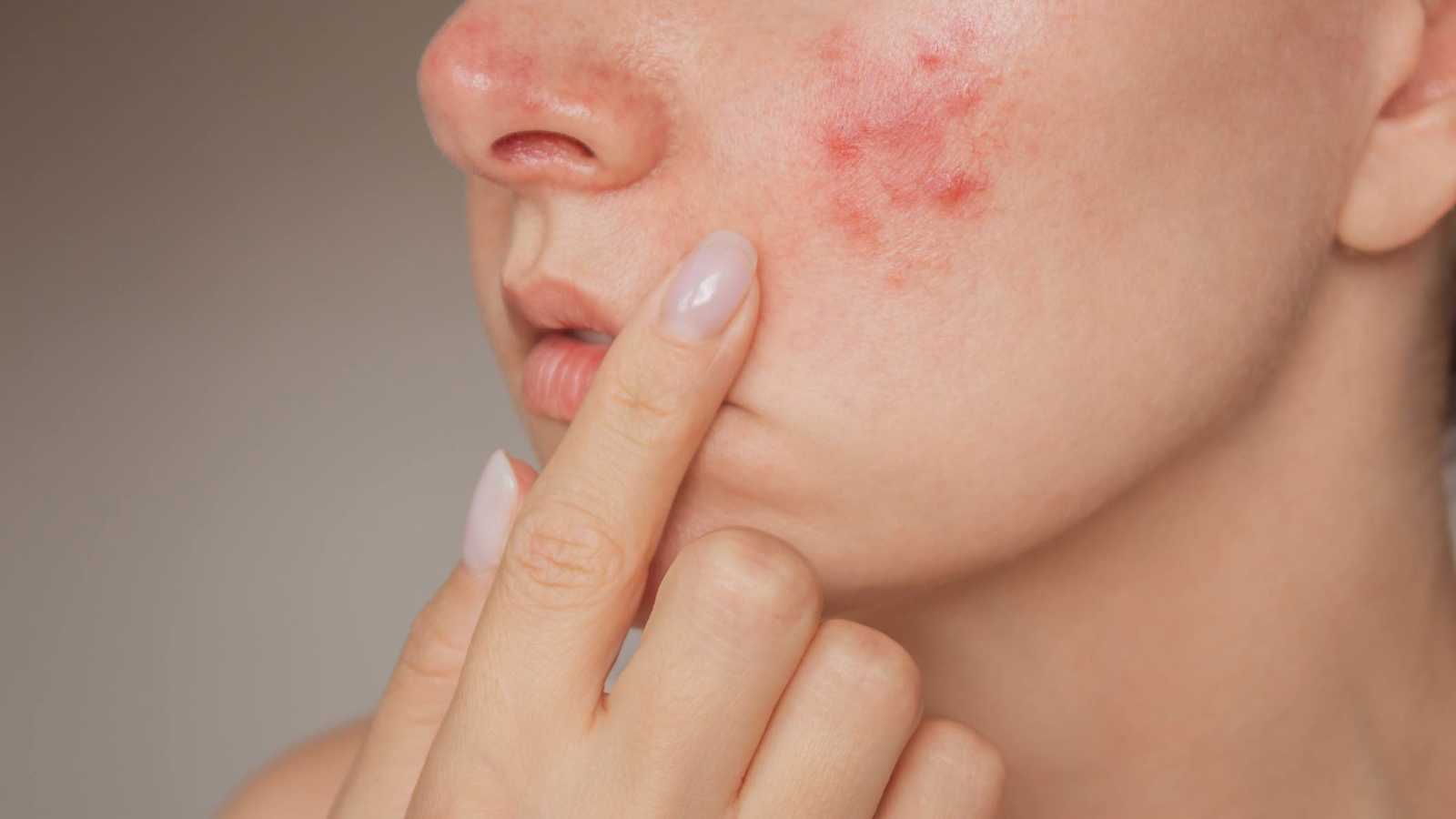 "مثلث الموت".. بثور صغيرة قد تهدد صحة الدماغ