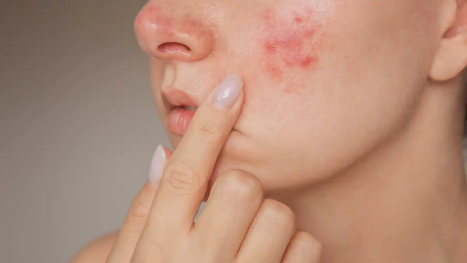 "مثلث الموت".. بثور صغيرة قد تهدد صحة الدماغ