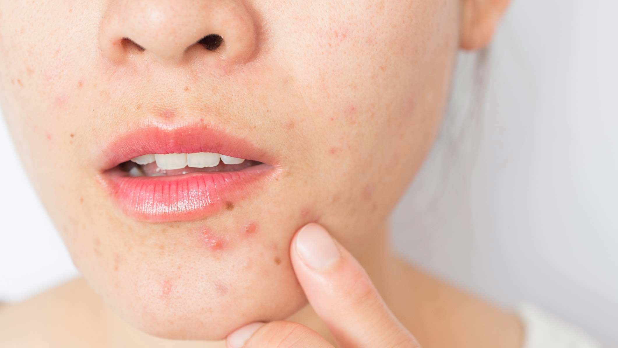 فاكهة "مذهلة" تساعد على التخلص من حب الشباب