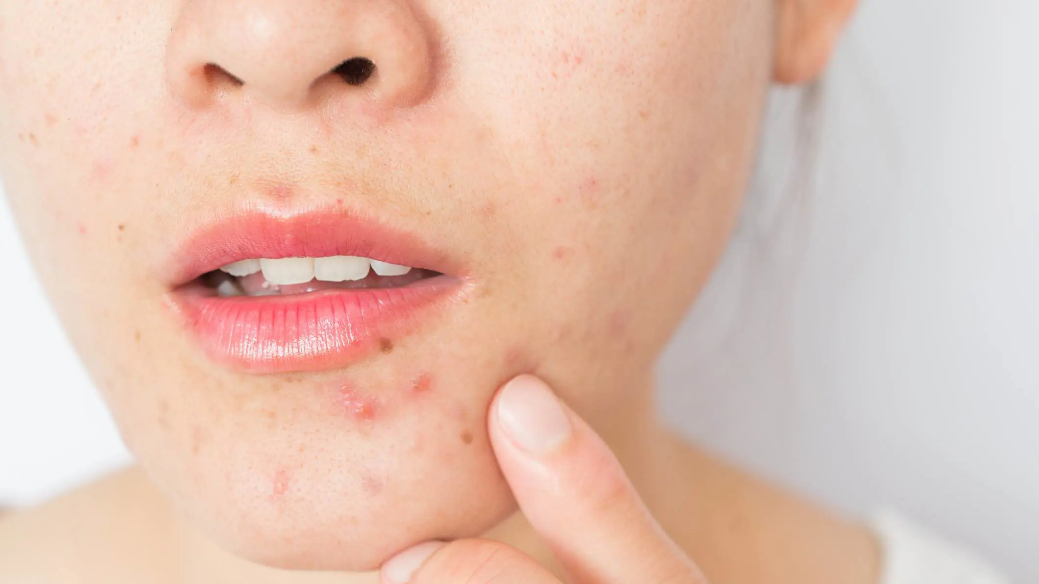 فاكهة "مذهلة" تساعد على التخلص من حب الشباب