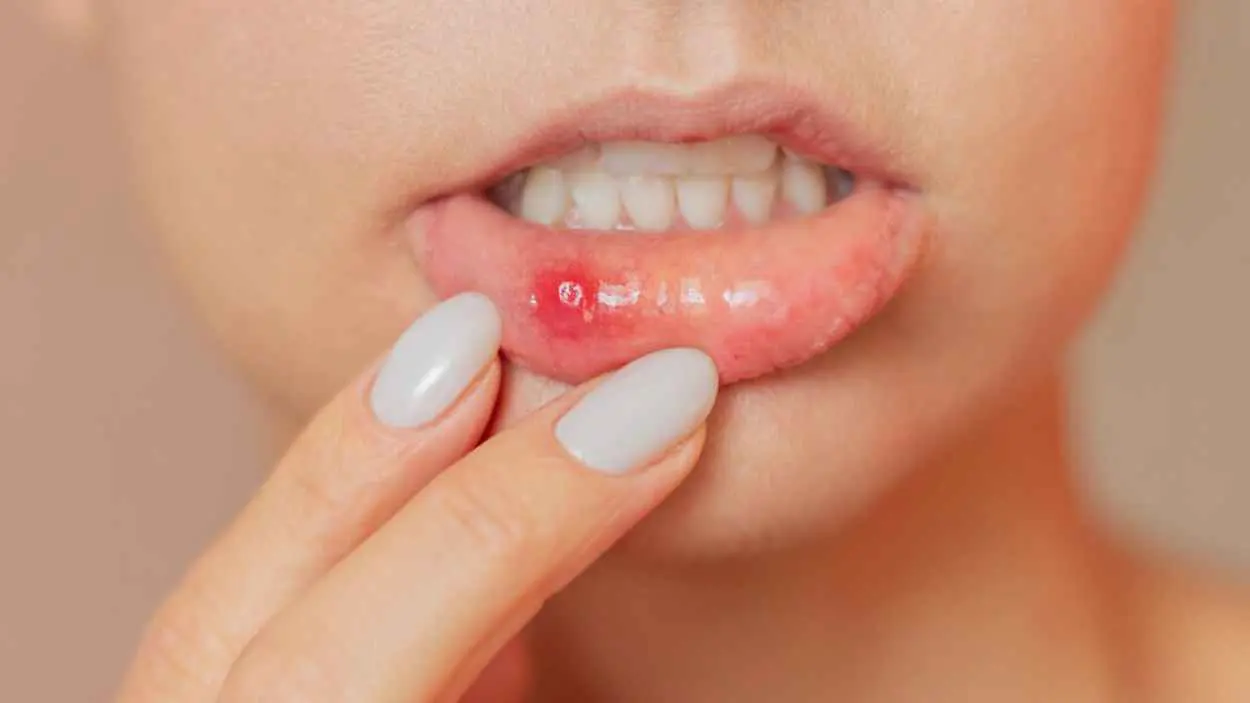 قائمة الأطعمة المنصوح بها لمعالجة تقرحات الفم المتكررة
