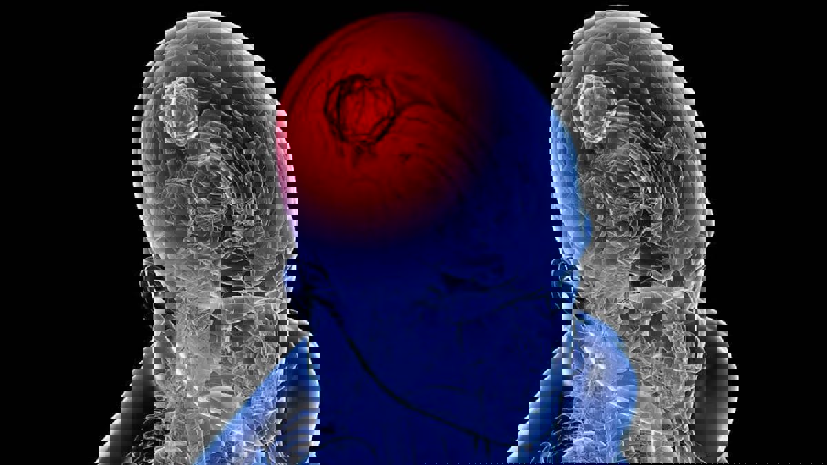 ابتكار "غرسة ثورية" لقتل أورام المخ بالأشعة تحت الحمراء