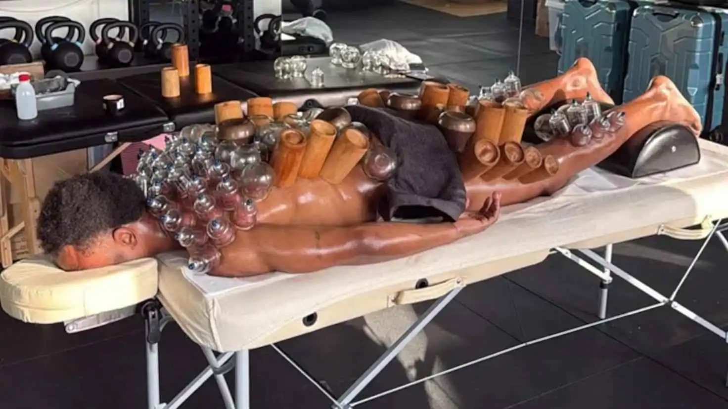 علاج فعال أم وهم؟.. حجامة اللاعب أوبيندا تثير الجدل في إيطاليا (فيديو إرم)