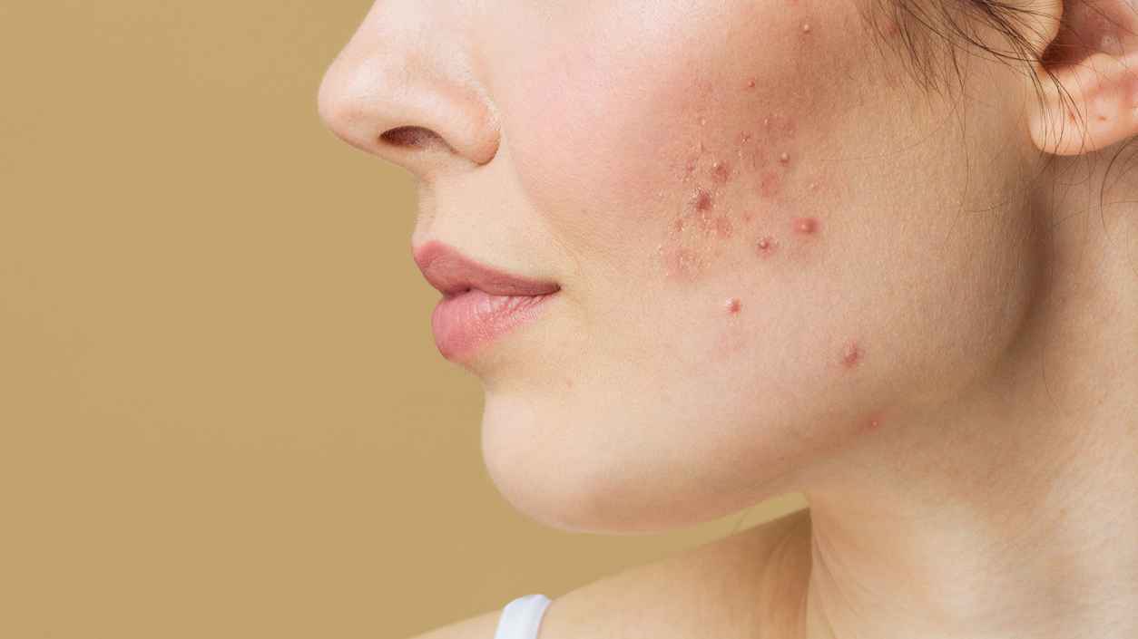 من جسر الأنف إلى زوايا الفم.. احذر "البثور القاتلة"