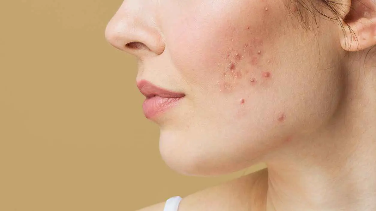 من جسر الأنف إلى زوايا الفم.. احذر "البثور القاتلة"
