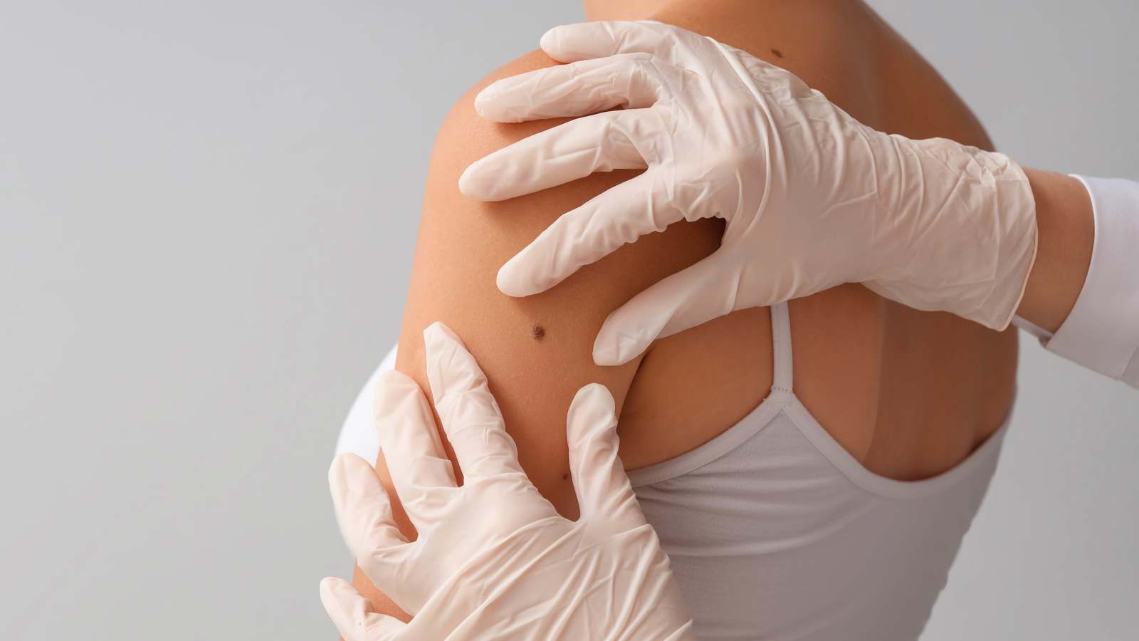 طريقة "بسيطة" لرصد علامات سرطان الجلد عبر الشامات