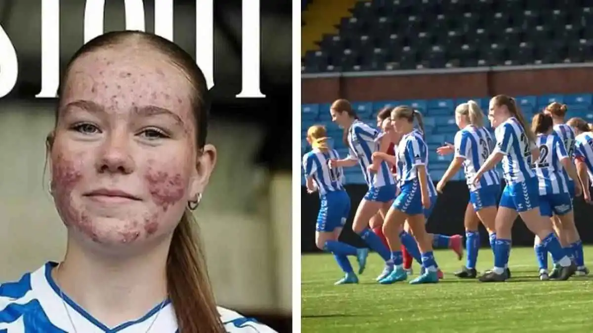 سخروا منها بسبب حَب الشباب.. سكاي ستاوت ترد بهدف خرافي من ضربة ثابتة (فيديو)