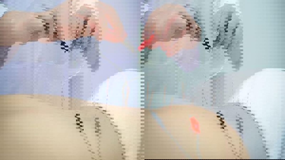 "الوخز الكهربائي" يقلل خطر انسداد الأمعاء بعد الجراحة لفترة طويلة