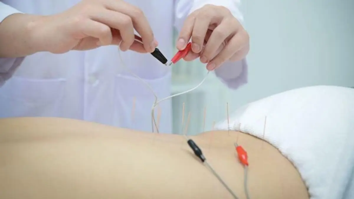 "الوخز الكهربائي" يقلل خطر انسداد الأمعاء بعد الجراحة لفترة طويلة