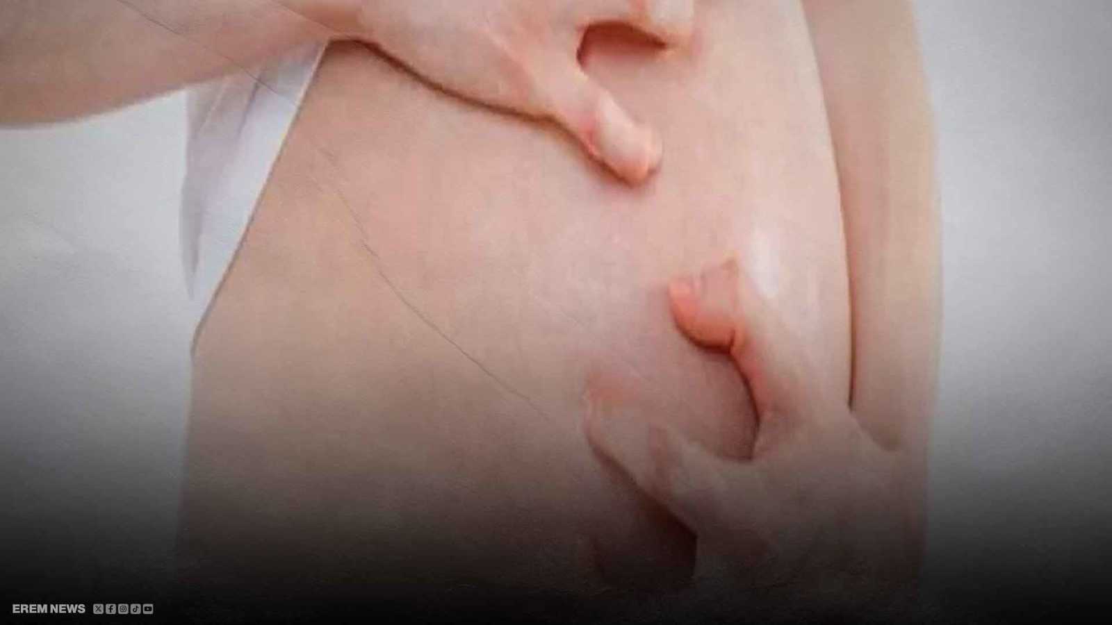 ترفض السائل المنوي.. حساسية نادرة تحرم سيدة من الإنجاب