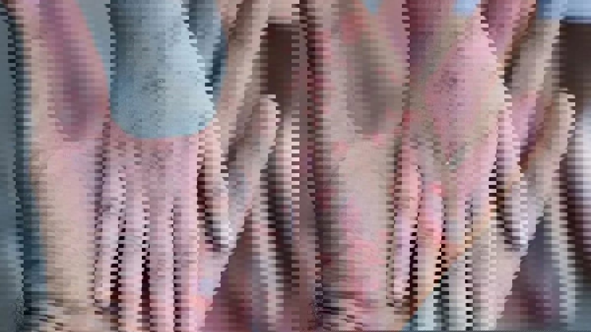 المغرب يرصد 3 حالات يشتبه في إصابتها بـ"جدري القرود"