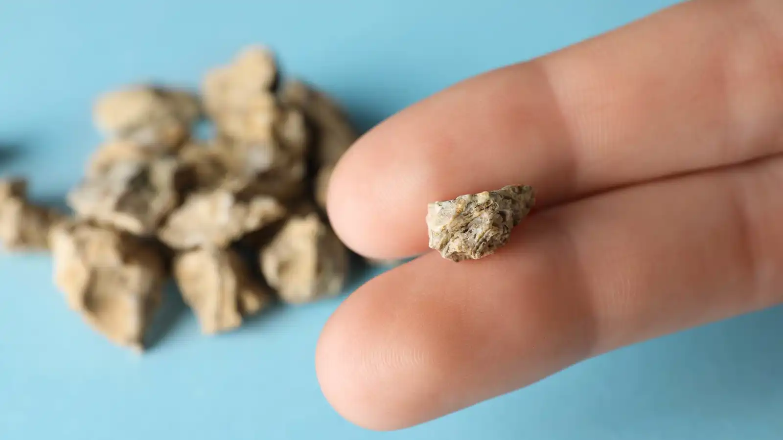 العلاجات المنزلية أم الطبية.. ما الأفضل للتعامل مع حصى الكلى؟