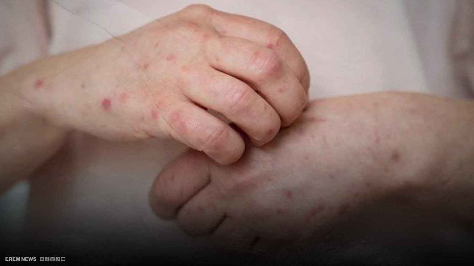 قفزة صادمة بالإصابات.. مرض جنسي يغزو مدينة أمريكية